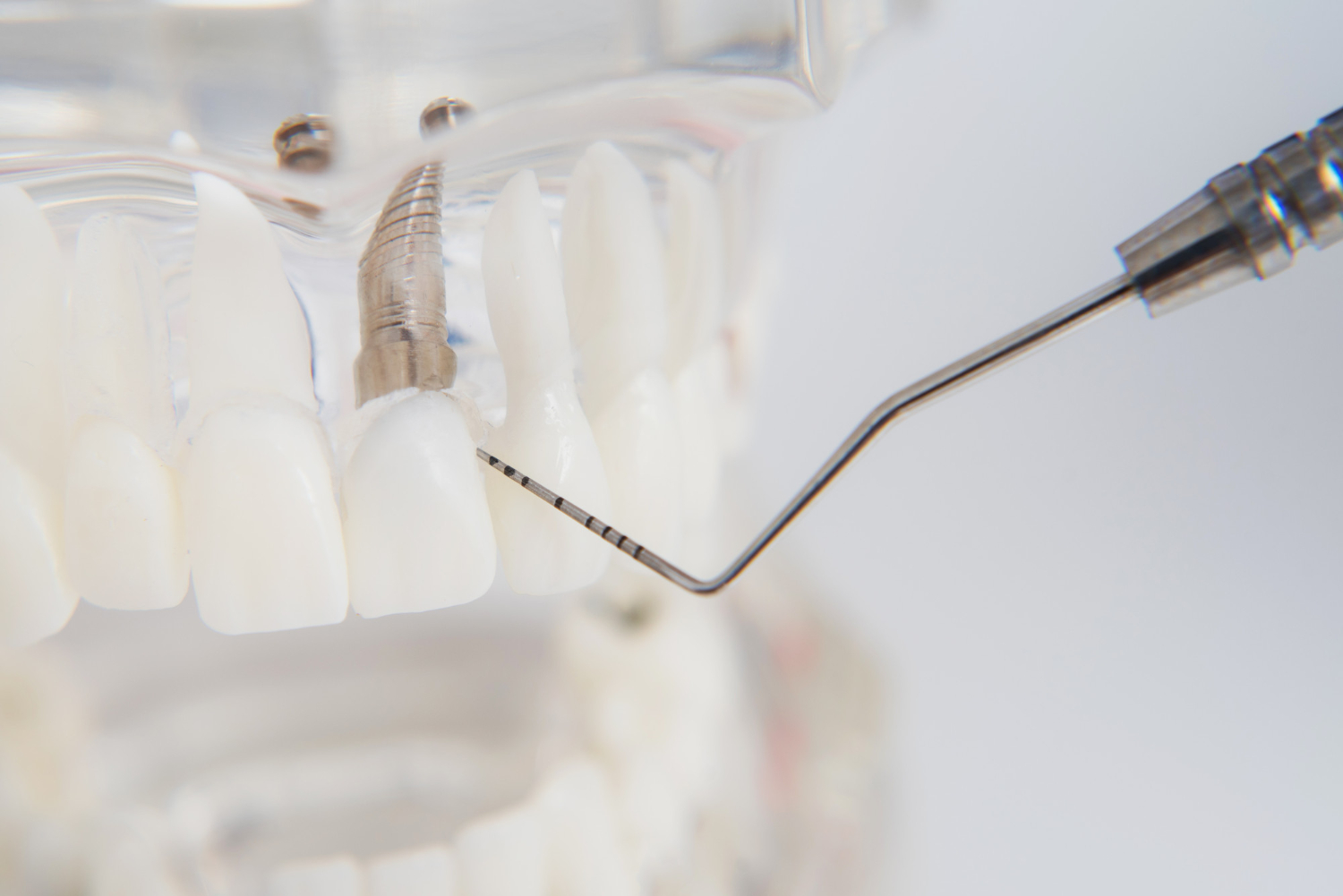 impianti-dentali-soave-dental