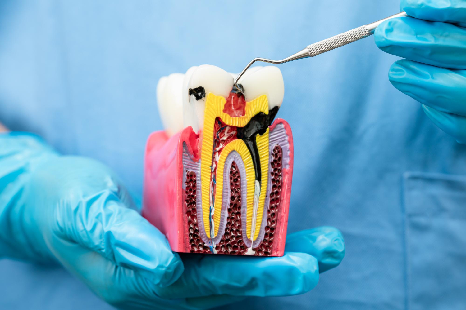 carie-soave-dental