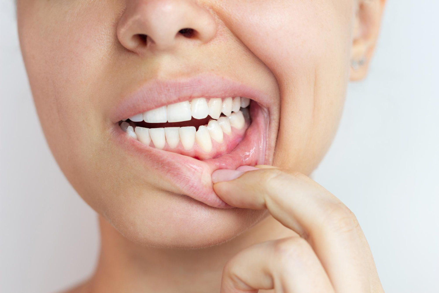 piorrea-denti
