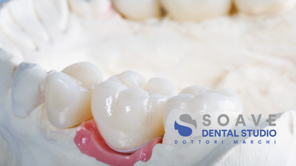 Quando serve una corona dentale per curare una carie?