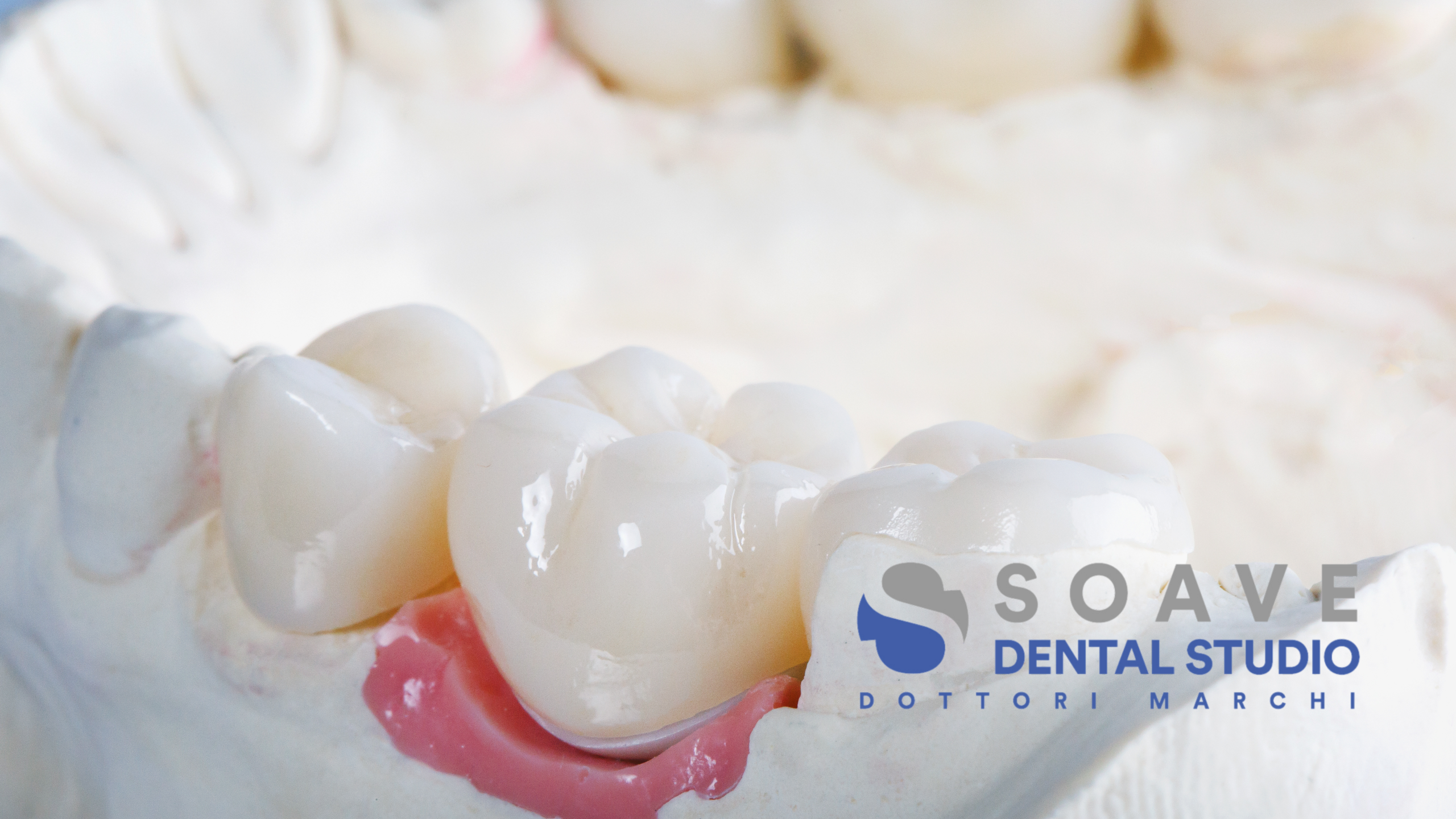 Quando serve una corona dentale per curare una carie?
